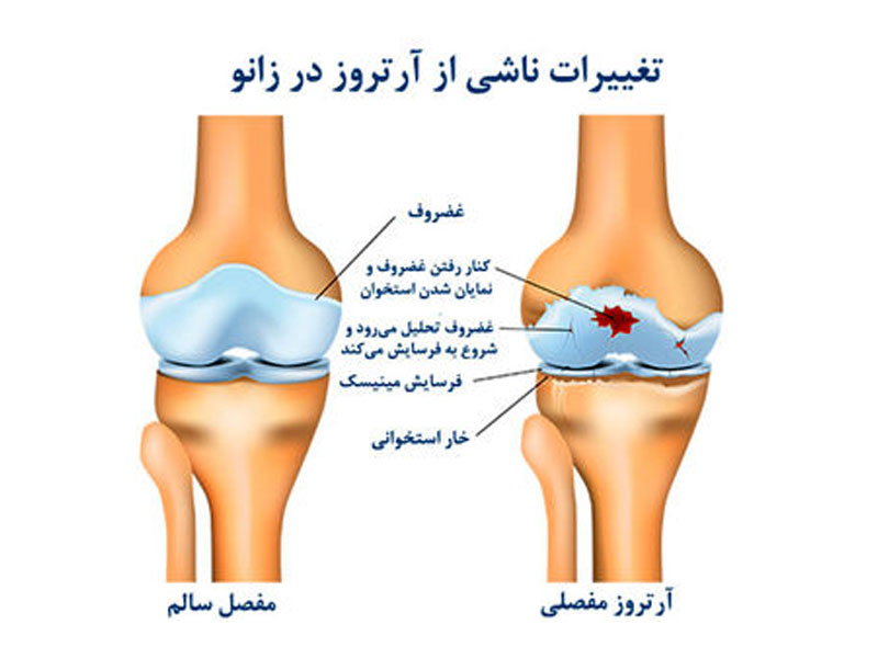درمان آرتروز زانو