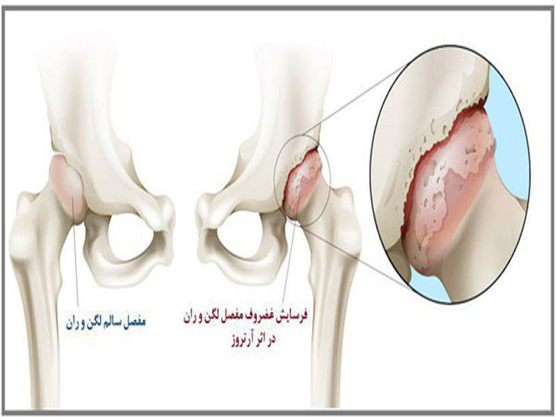 آرتروز لگن