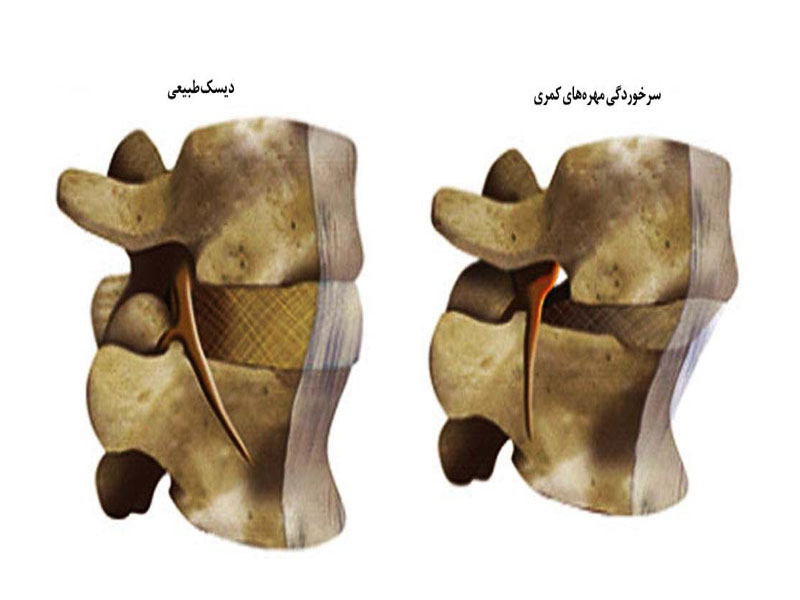 شکستگی و سرخوردگی مهره های کمر